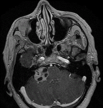 IRM d 'un neurinome de l'acoustique droit