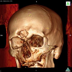 Reconstruction 3D du scanner du même patient montrant la perte de substance osseuse