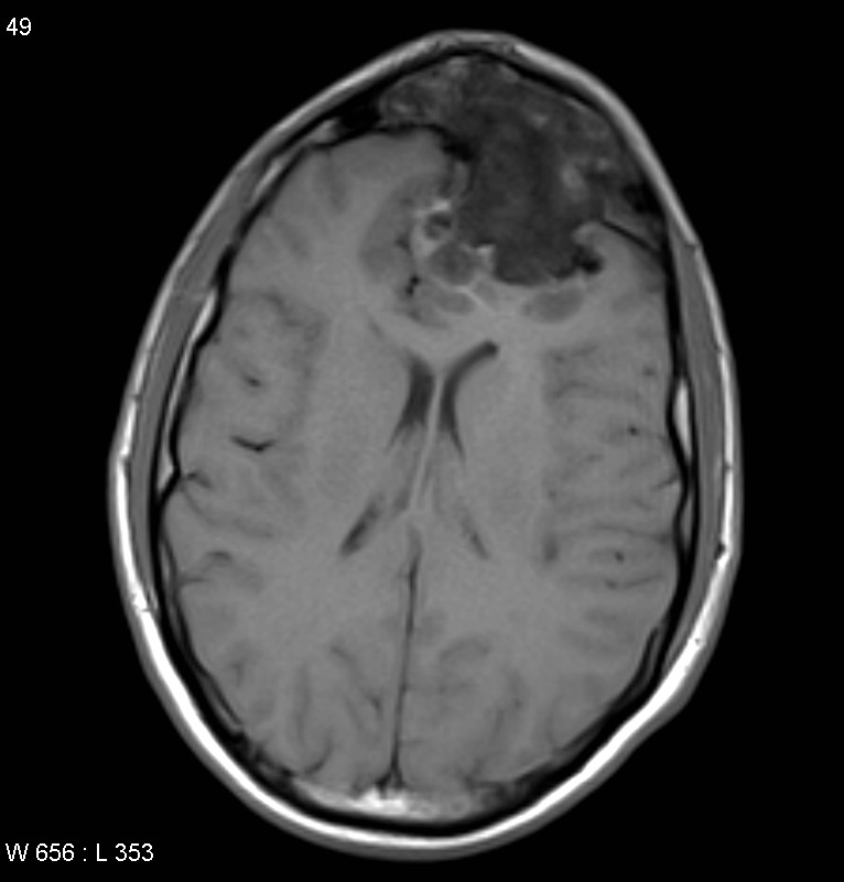 IRM d'une volumineuse lésion du sinus frontal refoulant le lobe frontal